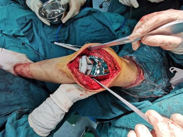 类风湿关节炎的关节置换