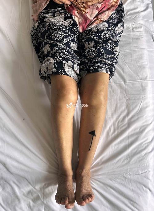 类风湿关节炎的关节置换