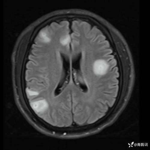 脑梗病灶可见弥散受限