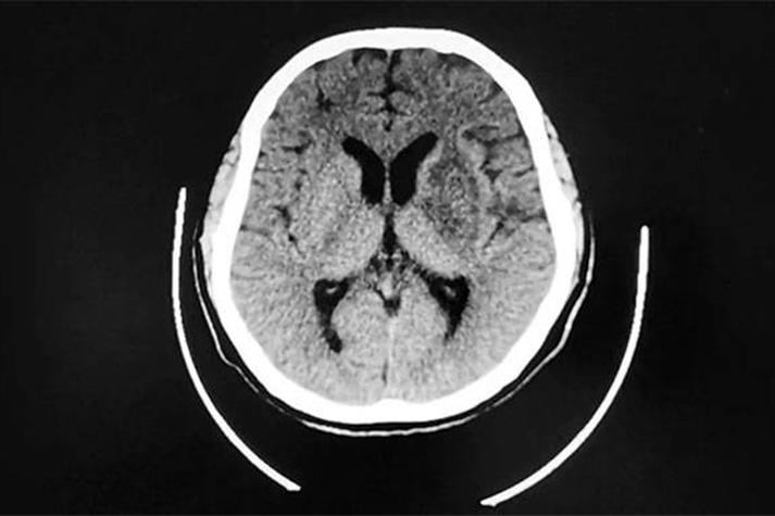 脑梗病灶可见弥散受限