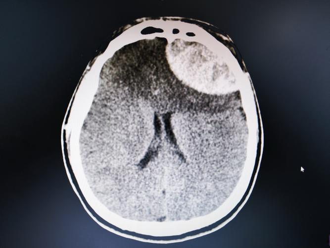 脑梗病灶可见弥散受限