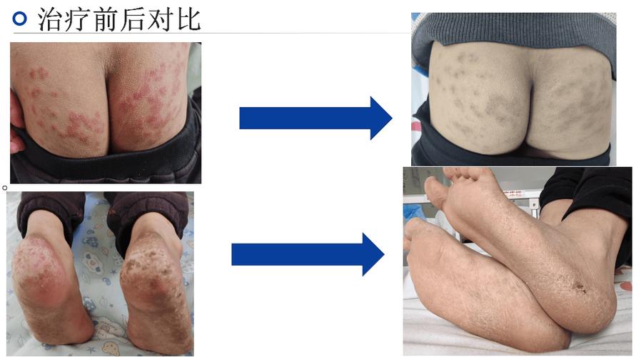 类风湿和红斑狼疮的区别