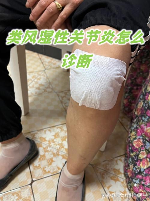 类风湿因子370严重吗