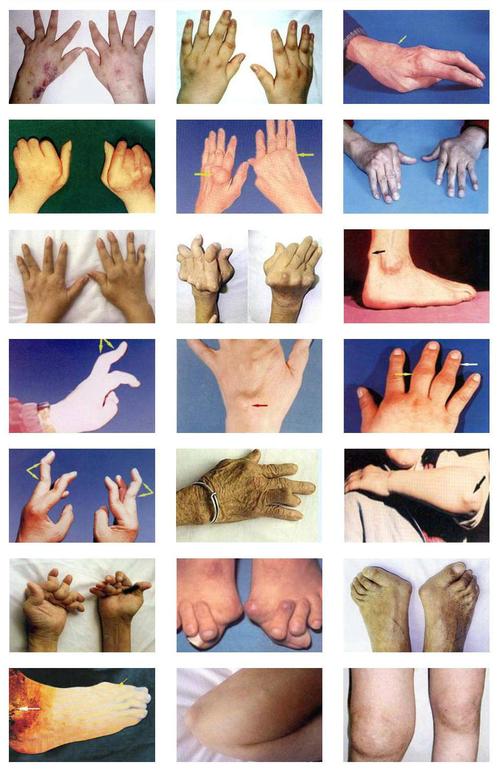 类风湿因子370严重吗