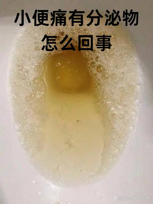 脑梗病人 口渴 多尿