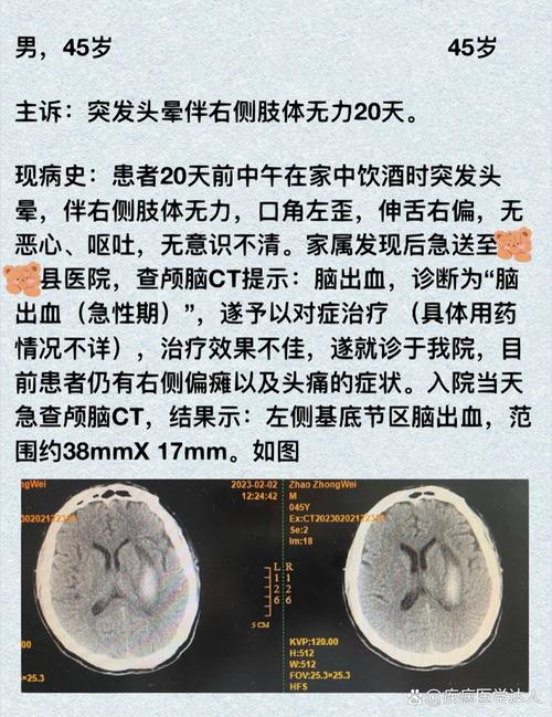 脑梗之后正中神经损伤