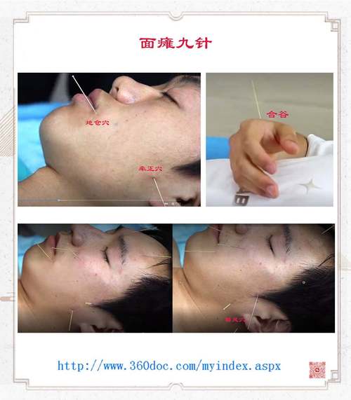 嘴角生疮针灸什么穴位