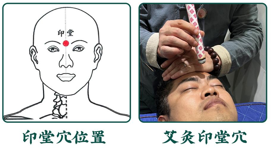 喝酒头痛艾灸什么穴位