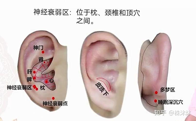 耳朵什么穴位治疗失眠