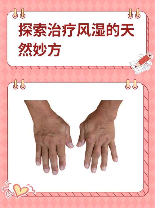 合肥治疗风湿的治疗方法