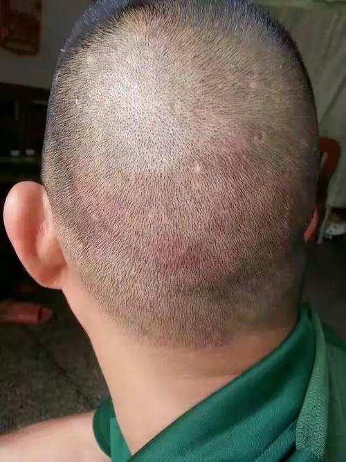 南宁有效风湿医院 39