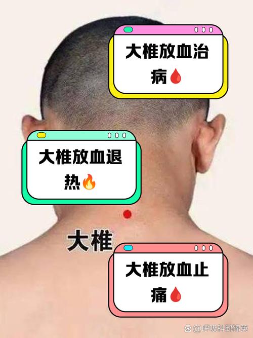 肩周炎的穴位放血疗法