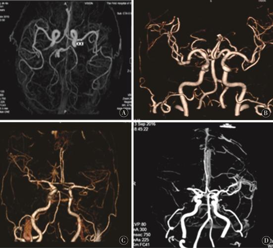 骨髓肽 脑梗 血管窄