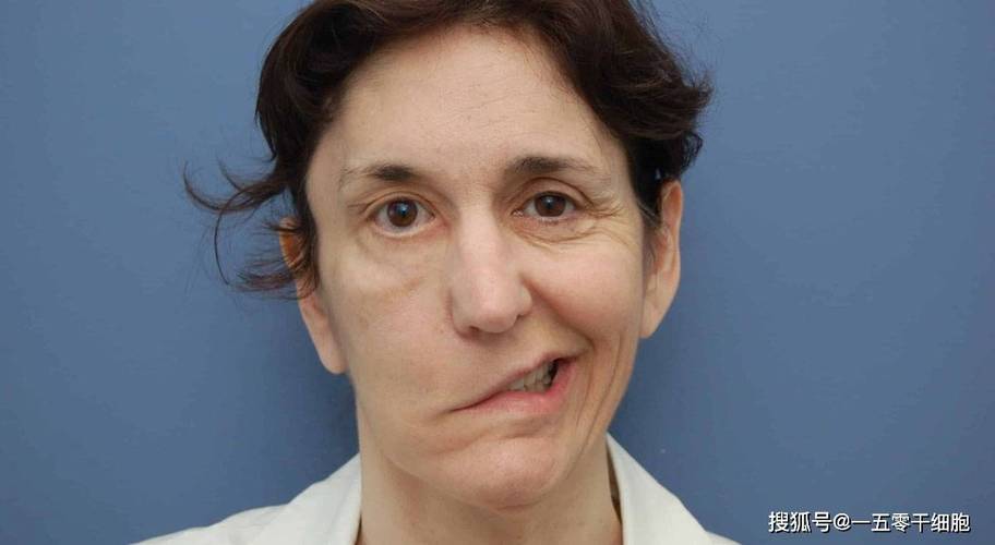 脑梗引起面部麻木僵硬