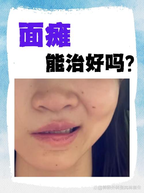 脑梗引起面部麻木僵硬