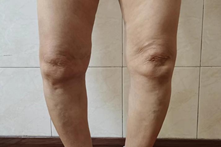 类风风湿性关节炎活动后