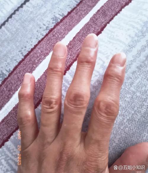 类风风湿性关节炎活动后