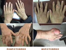 类风风湿性关节炎活动后