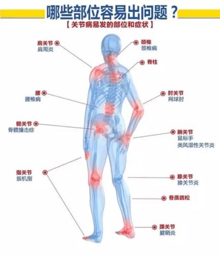 类风湿性关节炎关节类型