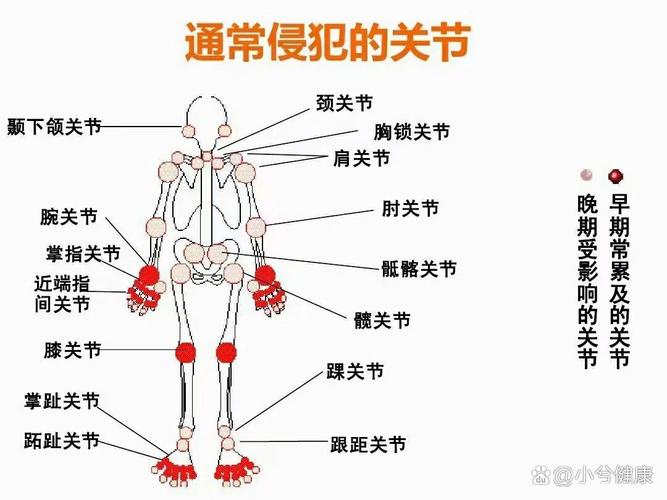类风湿性关节炎关节类型