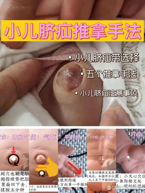 小儿疝气如何按摩穴位