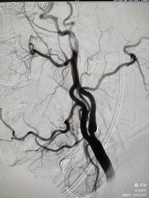 左边脑梗右边血管开始