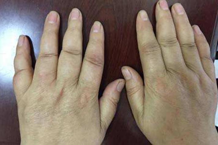 女性风湿早期症状有哪些