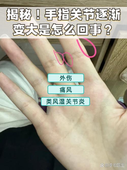 女性风湿早期症状有哪些