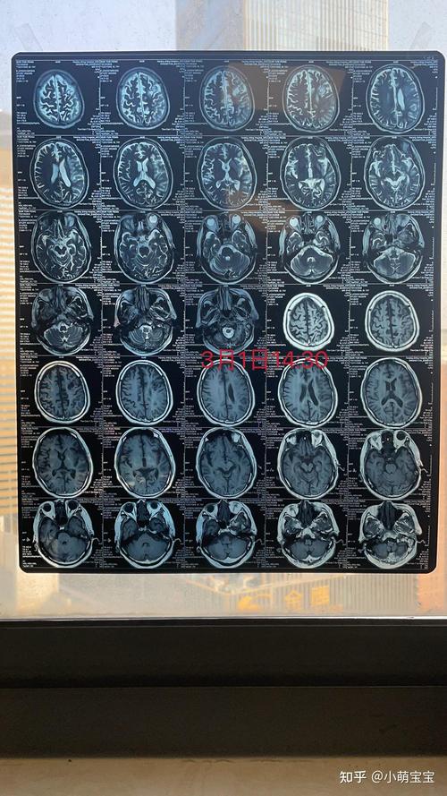 中国广西脑梗医院排名