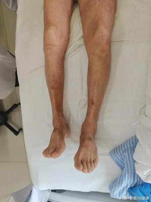 脑梗患者下肢出现大包