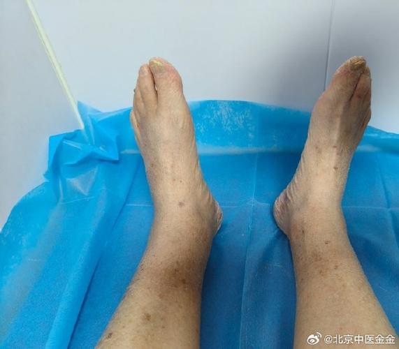 脑梗患者下肢出现大包