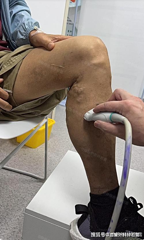 脑梗患者下肢出现大包