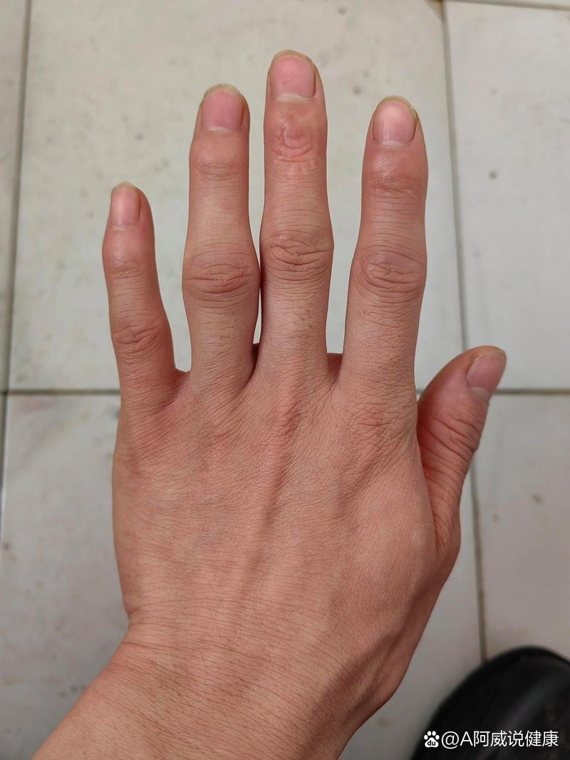手指风湿性关节炎的症状