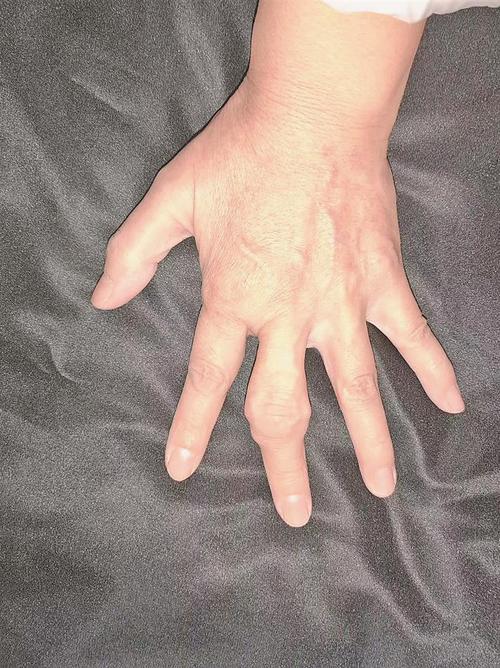 手指风湿性关节炎的症状