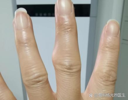 手指风湿性关节炎的症状