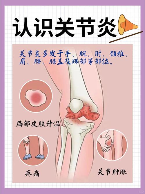 膝盖风湿关节炎怎么治疗