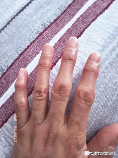 风湿性关节炎有什么症状