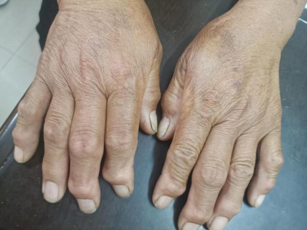 风湿性关节炎有哪些症状