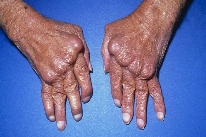 风湿性关节炎是什么症状