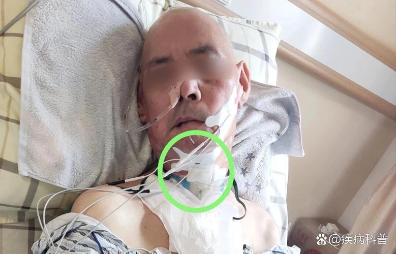 脑梗病人吞咽障碍图片