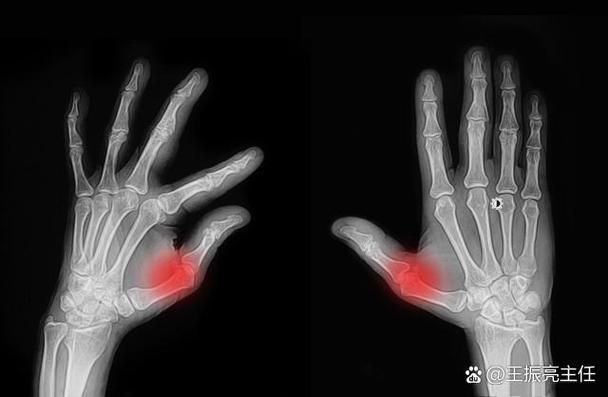 风湿疾病pcna阳性