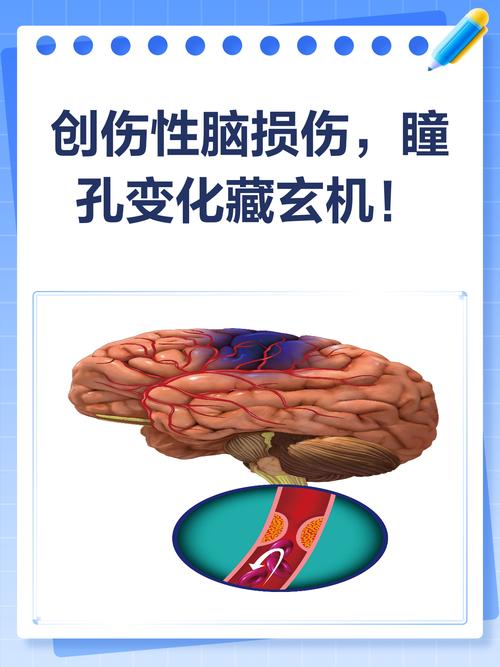 脑梗瞳孔神志观察变化