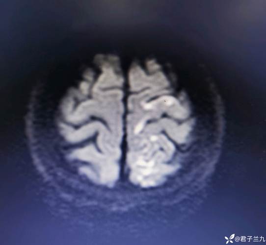 股骨骨折患者再发脑梗