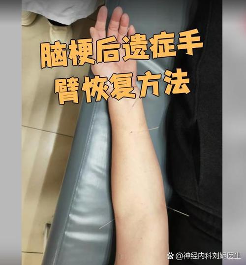 脑梗患者胳膊如何康复