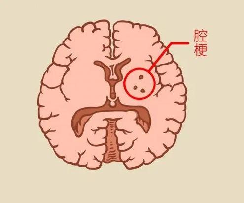 新旧脑梗ct怎么区分