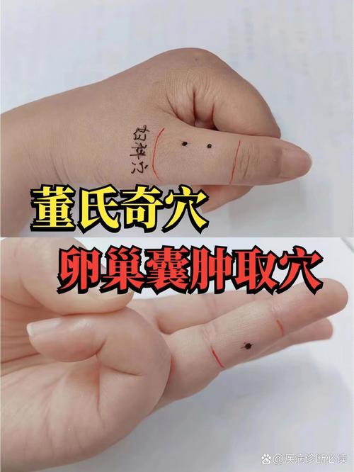 不孕不育 针灸 穴位