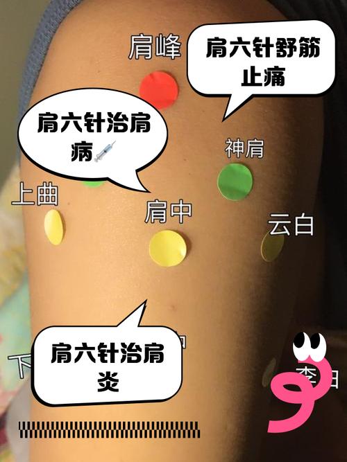 肩周炎dian针穴位