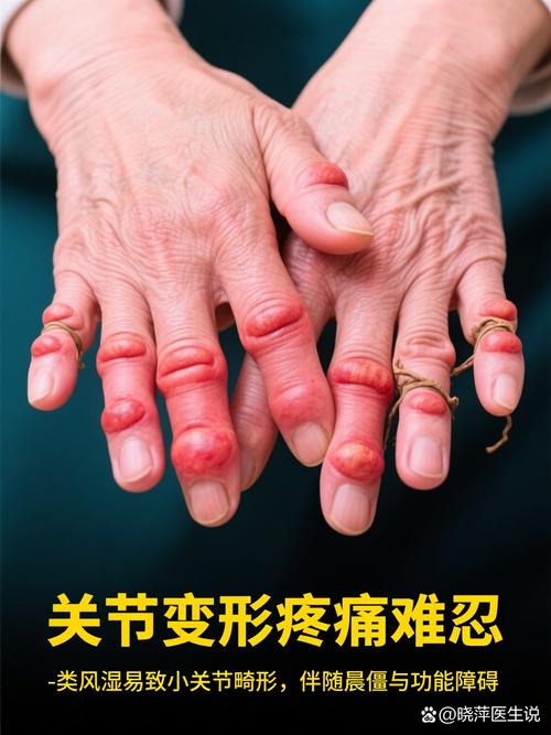 风湿热跟类风湿一样吗