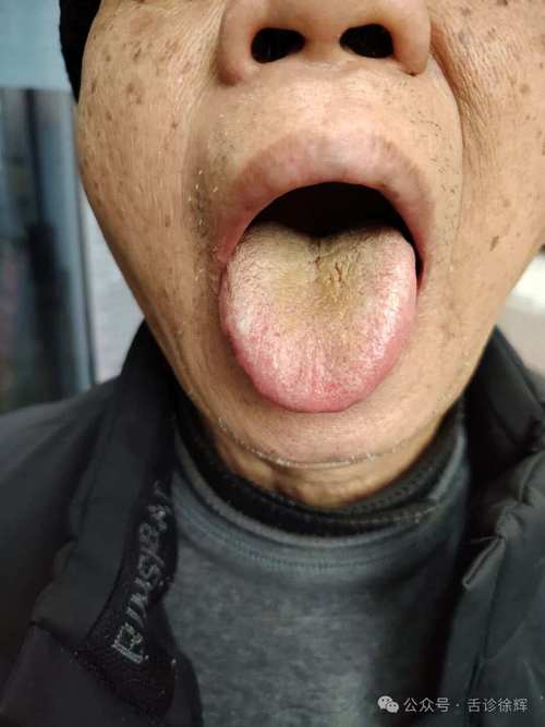 脑梗病人舌头貌似缩短