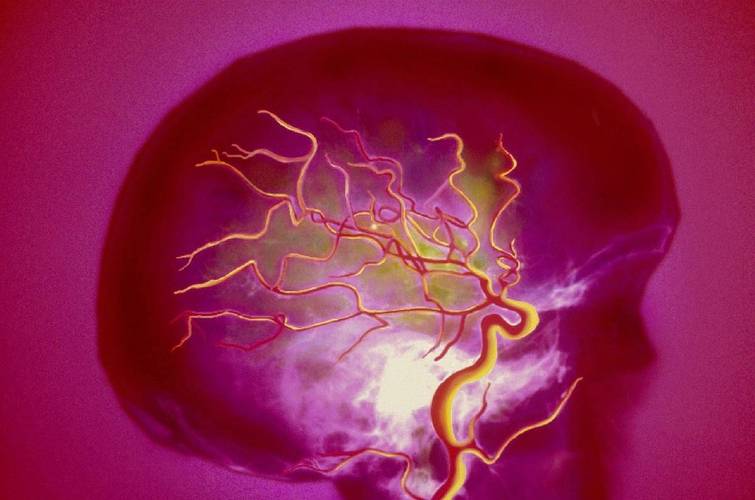 脑梗病人眼球出现红色